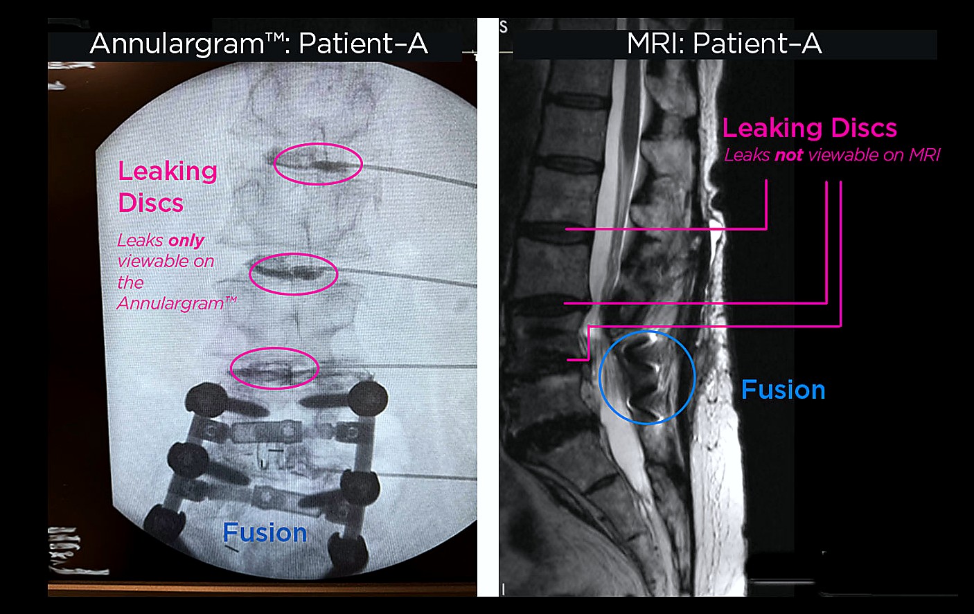 An Annulargram uses live X-ray contrast to identify disc tears an MRI can miss.