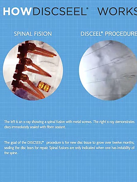 Discseel Procedure does not require fusion. Outpatient. Same-day walking.