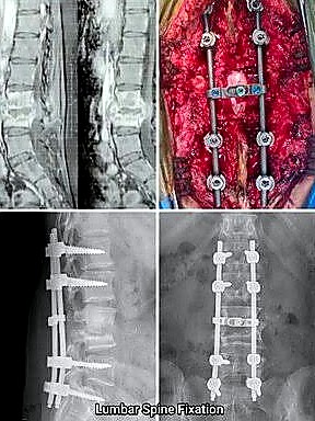 Lumbar spine fixation: MRI, open-back surgery with rods and screws, and X-rays. Discseel Procedure is not open fusion.