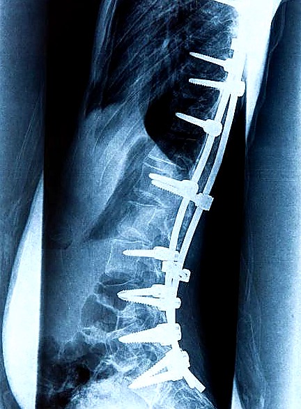 Side X-ray of multilevel spinal fusion from thoracic through lumbar spine with rods and screws. Discseel Procedure has no metal implants.