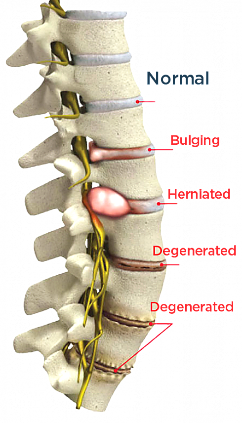 Spinal discs: normal, bulging, herniated, and degenerated. Discseel Procedure education.