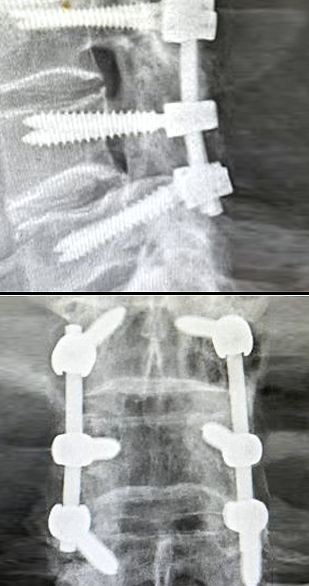 Side and front X-rays of spinal fusion with pedicle screws and rods. Discseel Procedure leaves no implants.