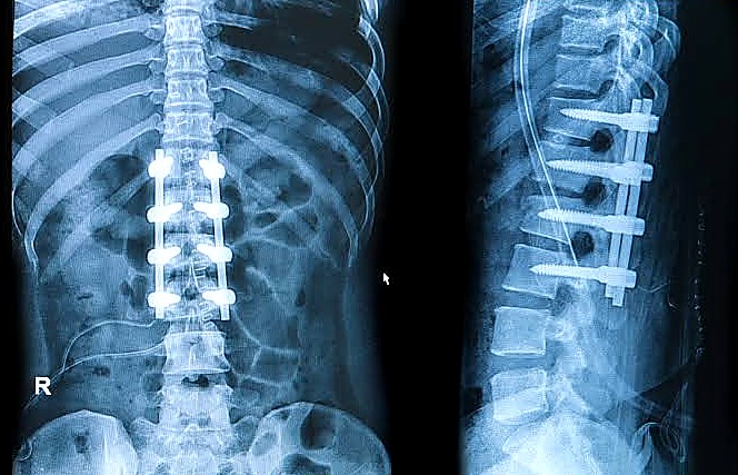 Front and side X-rays of lumbar spinal fusion with rods and pedicle screws. Discseel Procedure uses no metal implants.